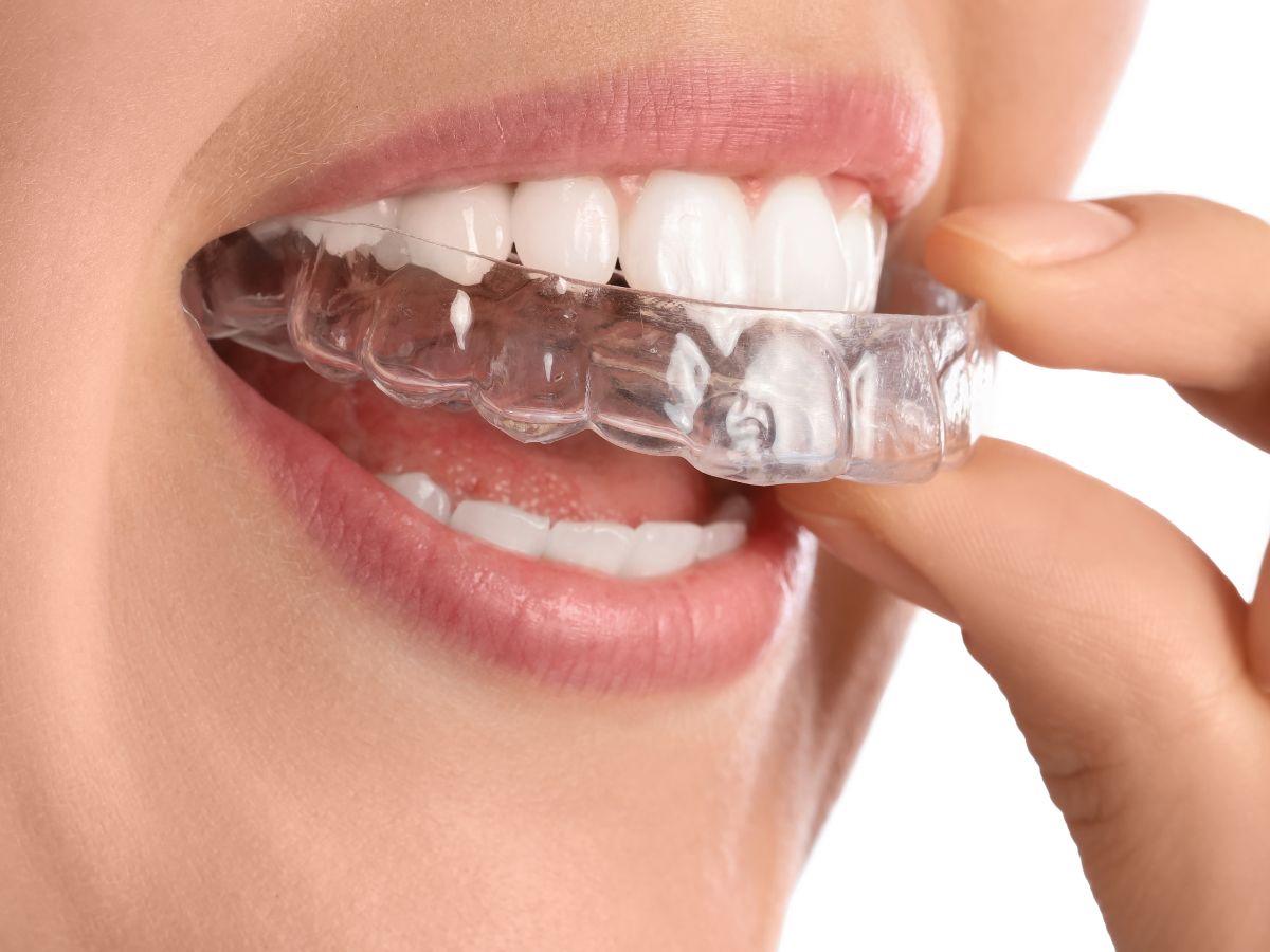 Braces and Aligners