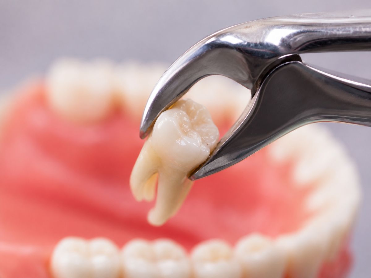 Tooth Extraction